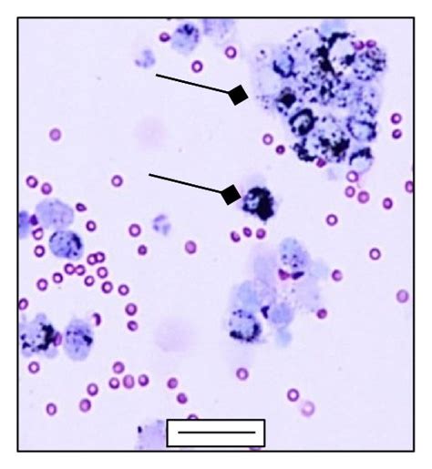 Differential Staining Of BALf Cells A Alveolar Macrophages In The