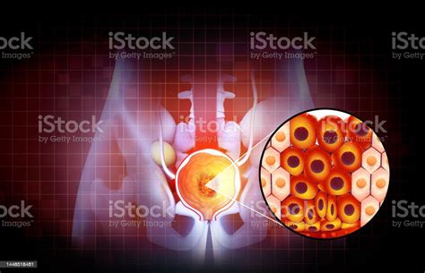 Prostate Disease Benign Prostatic Hyperplasia Prostate Cancer 3d