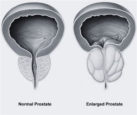 Understanding Prostate Cancer Causes Symptoms And Treatment Options