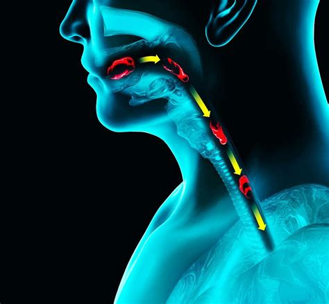 Esophageal Dysmotility