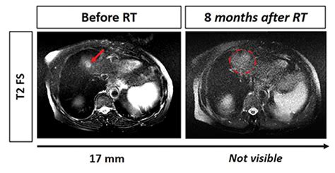 Efficacy of Stereotactic Body Radiation Therapy in Recurrent Intrahepatic Cholangiocarcinoma ...