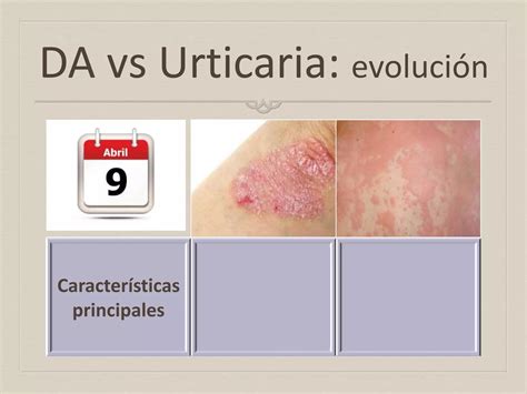 Diferencias Entre Dermatitis Atópica Y Urticaria Prof Ortega Martell