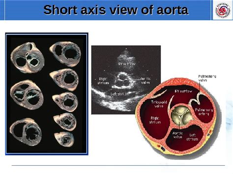 Transthoracic Echocardiography Standard Imaging Of A