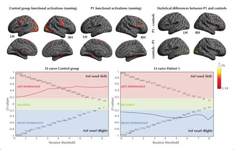 JLE Epileptic Disorders Multimodal Assessment Of Language And