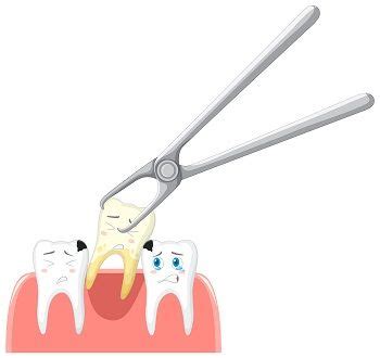 Tooth Extraction Recovery Tips For A Speedy Heal Dental Implant Solutions