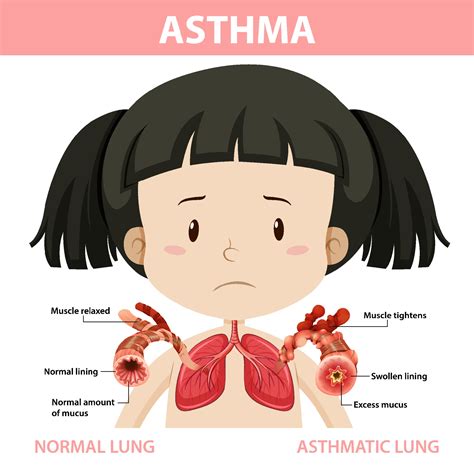 Asthma Lung Diagram