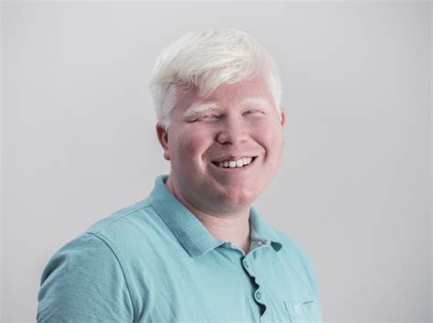 Альбинизм: признаки, типы, лечение, последствия