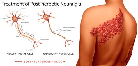 Treatment of Post-herpetic Neuralgia (Nerve Pain After Shingles Attack ...