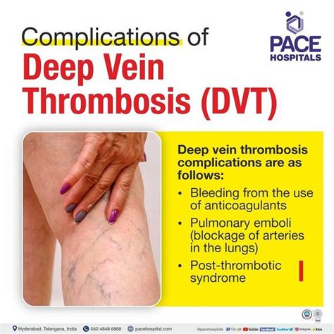 Deep Vein Thrombosis, DVT Symptoms, Causes And, 41% OFF