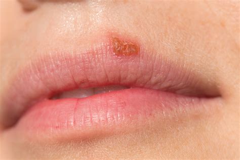 Cold Sores In Mouth