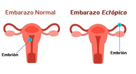 ¿qué Es El Embarazo Ectópico Centro Clínico Fenix Salud