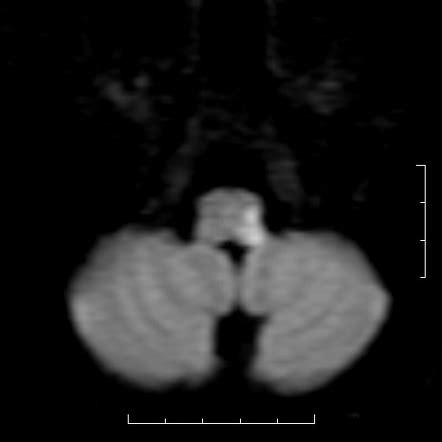 Lateral Medullary Syndrome Pictures