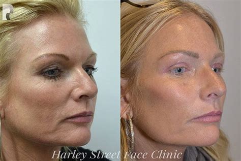 Non Surgical Facelift Is The No Knife Procedure Worth The Hype