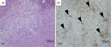 Immunohistochemical Staining Of Resected Adrenal Gland Metastasis A