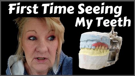 Wax Try In Immediate Dentures Seeing My Dentures For The First Time