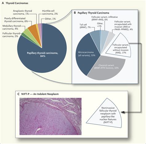 Biologic And Clinical Perspectives On Thyroid Cancer Nejm