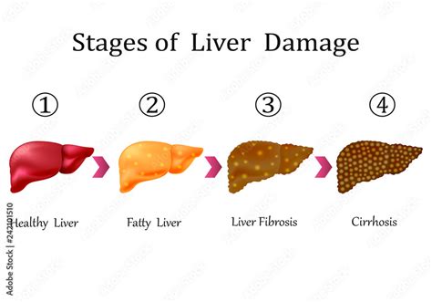 Stages of liver damage, liver disease. Healthy, fatty, liver fibrosis ...