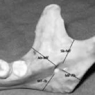 (PDF) Analytical Study of Location of Mandibular Foramen in Human Dry ...