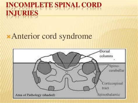 Spinal Cord Injury Pptx