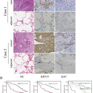 Immunohistochemistry Analysis Of Krt In Lung Cancer Tissues