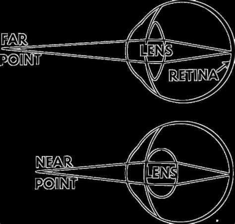 Accommodation Eye Alchetron The Free Social Encyclopedia