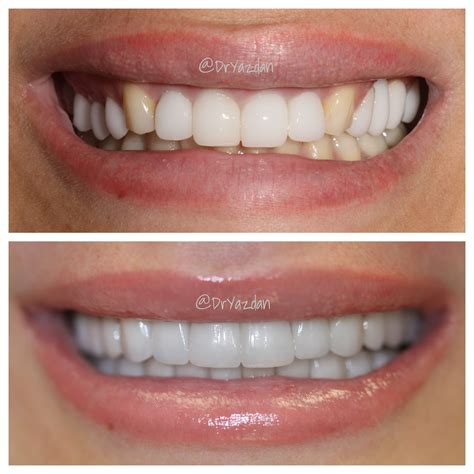 Full Mouth Reconstruction Using Veneers Crowns Bridges Notice The