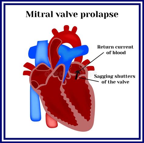 Mitral Valve Prolapse Diagram