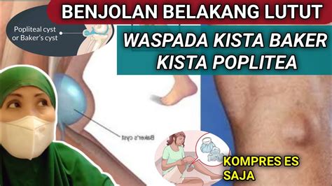 BENJOLAN DI BELAKANG LUTUT PENGOBATAN KISTA BAKER ATAU KISTA POPLITEA