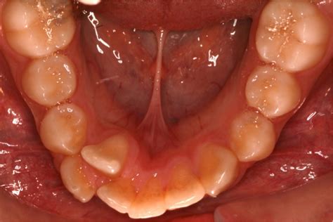 Orthodontic Update Management Of Lower Incisor Extraction Cases Part