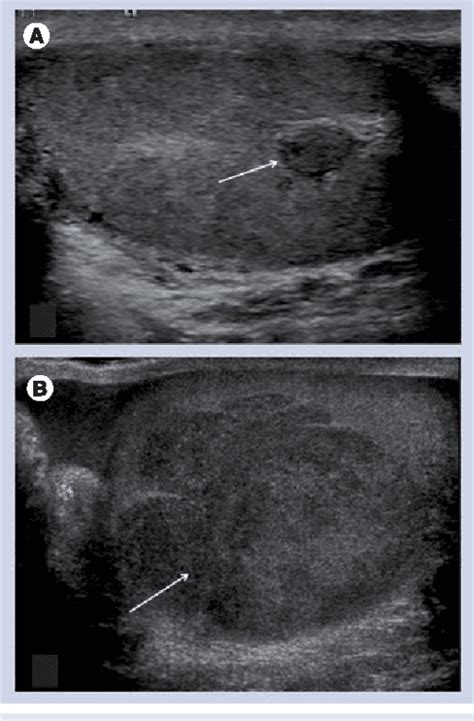 Figure 3 From Role Of Ultrasound In The Diagnosis Of Testicular Lesions