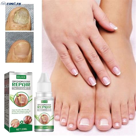 Eelhoe Onychomycosis Treatment Oil Nail Fungus Nail Fungal Infection