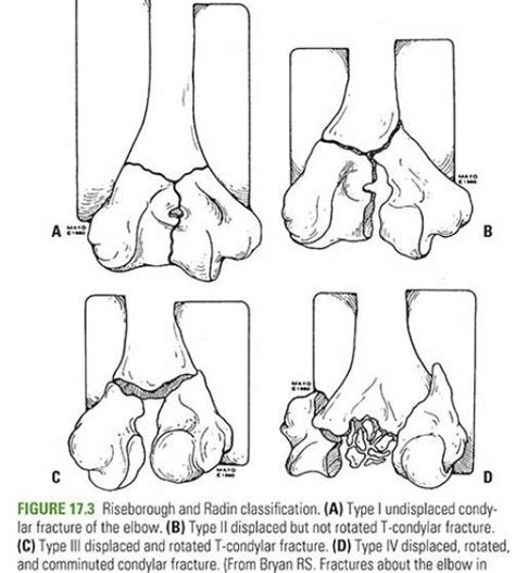 Intercondylar Fractures Distal Humeral Fracture Rayorthos