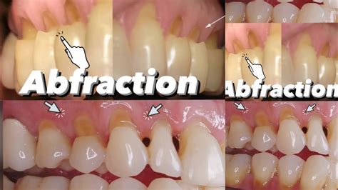 Dental Abfraction Youtube