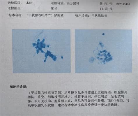 内分泌科开展甲状腺细针穿刺活检术 广东省中医院海南医院海南省中医院海南省中西医结合医院海南省中医药研究院