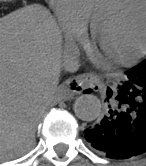 Distal Esophageal Perforation By A Fishbone Image Radiopaedia Org