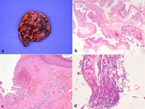 Dermoid Cyst In The Subcutaneous Tissues Of The Back A Rare Case With