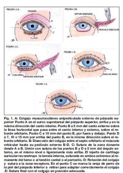 Aspecto Oral Precio Reconstruccion Parpado Inferior Deshabilitar