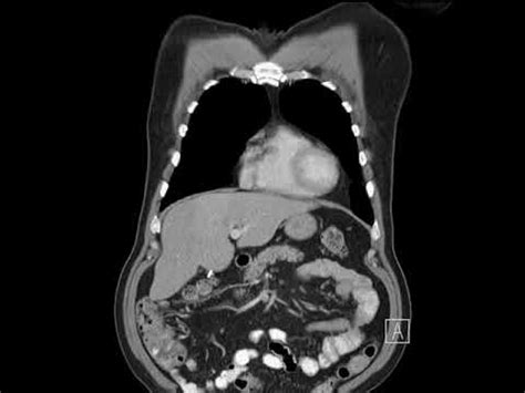 Esophagus Leiomyoma Distal Esophagus Coronal CT YouTube