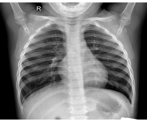 Classification Of Pediatric Pneumonia Using Chest X Rays By Functional