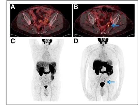 Figure 3 From An 18F Labeled PSMA Ligand For PET CT Of Prostate Cancer