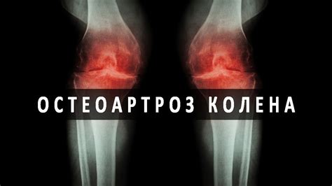 Остеоартроз коленного сустава - YouTube