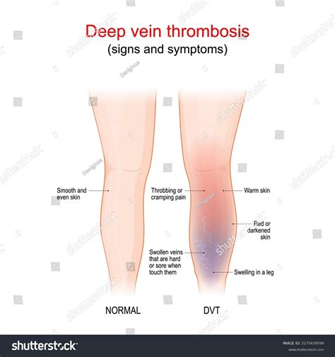 Thrombophlebitis