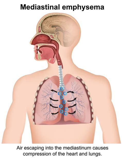 Mediastinal Tumors Symptoms and Treatment - News185