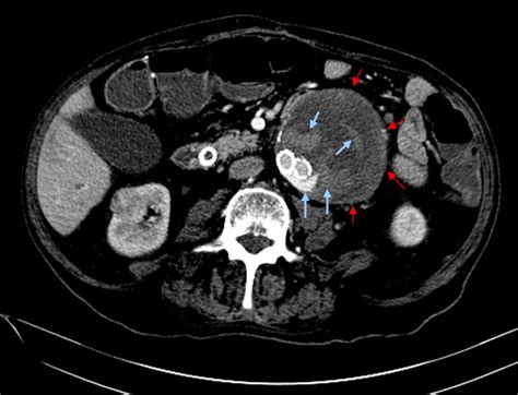 Endoleak: Diagnosis, Types and Treatment Options