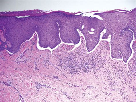 Recurrent Oral and Gluteal Cleft Erosions | MDedge Dermatology