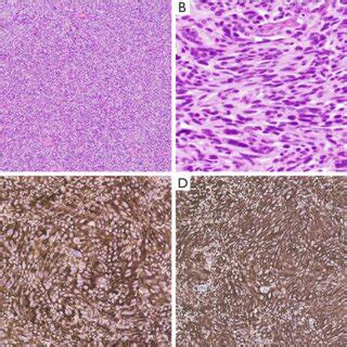 Spindle Cell Carcinoid Tumor Of The Thymus A Low Power View Of A