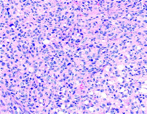 Pathology Outlines Pleomorphic Liposarcoma