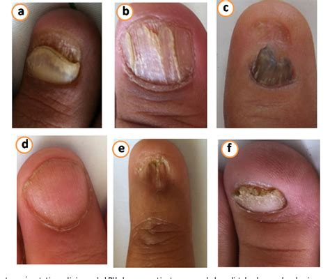 lichen planus of nail | Semantic Scholar