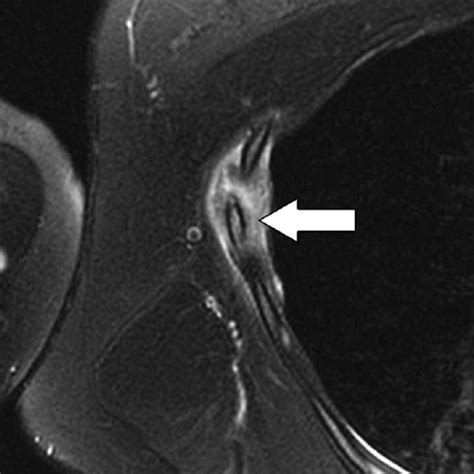 Musculoskeletal Imaging of Chest Wall Injuries in Athletes - ARRS ...