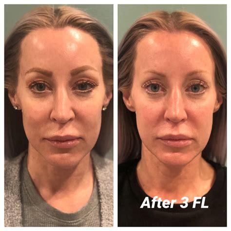 Natural Face Lift Massage Uplift Spa